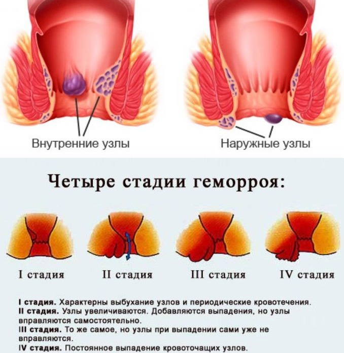 алая кровь на туалетной бумаге после стула